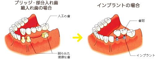 ブリッジ・部分入れ歯、総入れ歯の場合とインプラントの場合の比較図
