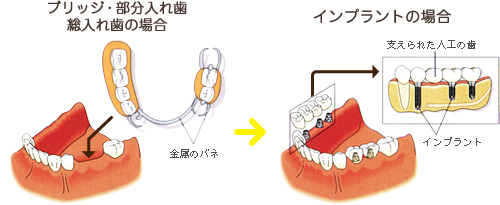 ブリッジ・部分入れ歯、総入れ歯の場合とインプラントの場合の比較図